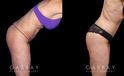 Before and after photos for body procedures, including a tummy tuck and inner thigh liposuction. Combining the procedures resulted in a flatter, smoother abdomen balanced with subtle yet effective tightening of the thighs. The final result evokes a more youthful contour.