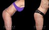 Before and after photos for body procedures, including a tummy tuck and inner thigh liposuction. Combining the procedures resulted in a flatter, smoother abdomen balanced with subtle yet effective tightening of the thighs. The final result evokes a more youthful contour.