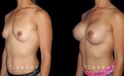 Patient recovered without complication and maintained a round, pleasing shape to her breasts. Scarring is hidden in the breasts natural folds, displaying only her positive results.