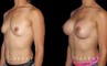 Patient recovered without complication and maintained a round, pleasing shape to her breasts. Scarring is hidden in the breasts natural folds, displaying only her positive results.