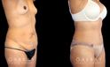 Patient before and after plastic surgery combination procedure involving breast augmentation (silicone implants), tummy tuck, and liposuction of the flanks. The combined results show a slimmer, more youthful profile with an enhanced feminine shape.