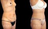 Patient before and after plastic surgery combination procedure involving breast augmentation (silicone implants), tummy tuck, and liposuction of the flanks. The combined results show a slimmer, more youthful profile with an enhanced feminine shape.