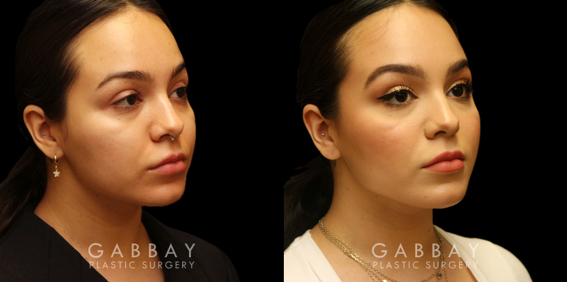 Procedures Depicted:  Buccal Fat Removal with Lipo to Chin