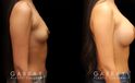 Breast augmentation for younger female patient. Note the pleasing roundness to the breasts that matches her natural body shape well for an attractive enhancement.