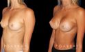 Patient results following complete recovery from breast augmentation procedure. Patient achieved increased bust size with a refined proportion to her slimmer torso and waist.