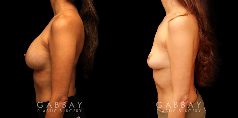 Procedures Depicted:  Implant Removal