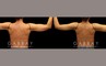 Procedures Depicted:  Liposuction to arms with j plasma