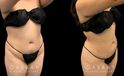 Patient who wanted mild liposuction to reduce tummy bulge from stubborn fat, with subtle results that lend a more balanced figure. Note how the puncture sites healed well for little to no visibility.