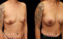Breast augmentation results after complete recovery. Careful placement of silicone implants resulted in natural breast appearance and position.