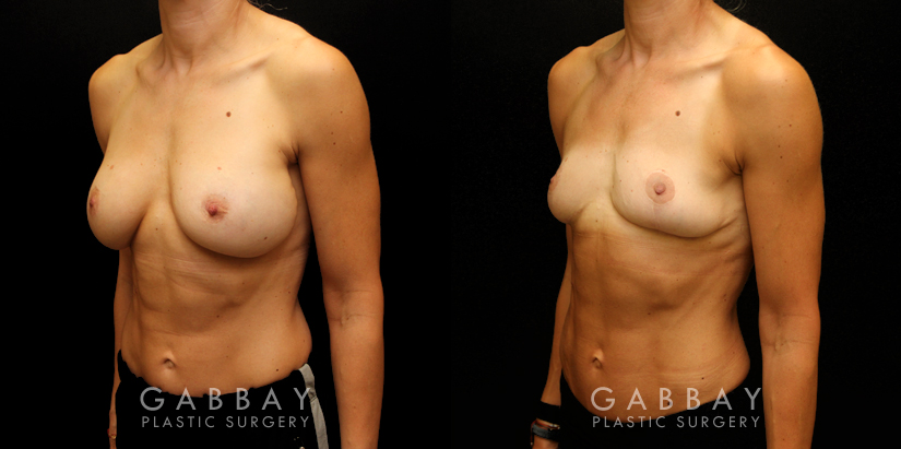 Procedures Depicted:  Implant removal/Mastopexy/Auto Augmentation