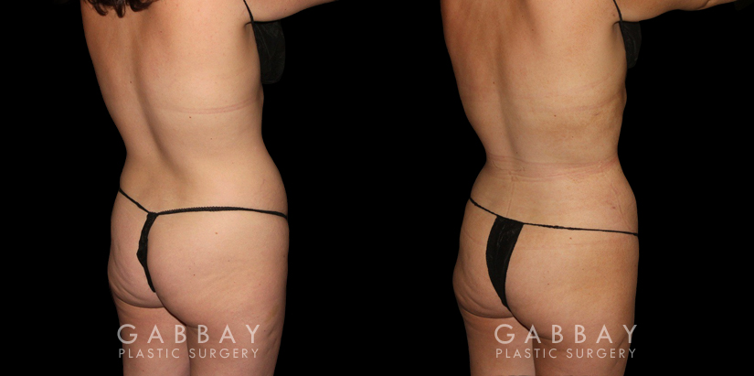 Procedures Depicted:  Mastopexy and Liposuction Before-and-after photos for female patient who underwent both a breast lift and belly fat removal via liposuction. Results together create a full ‘lifted’ appearance for the patient’s entire body.