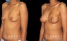 Silicone implants were used to increase breast volume while preserving the patient’s natural breast shape. The increased bust size resulted in a feminine, refined profile.