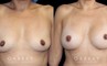 Breast augmentation results including silicone implant augmentation combined with tummy tuck and flank liposuction. The final result is a tightened body contour with enhanced breast size.