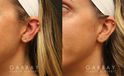 Patient 04 3/4th Left Side View Earlobe Repair Gabbay Plastic Surgery
