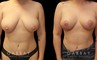 Patient 27 Front View Breast Mastopexy Gabbay Plastic Surgery