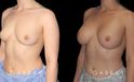 Smoother recovery for patient who chose silicone implants for breast augmentation. Breast position was maintained to keep a natural look that enhances her body type’s contours.