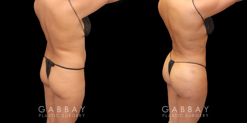 Patient 10Before and after results of fat transfer to butt for female patient. BBL surgery that took fat via liposuction from the abdomen, flanks, and waist with lipo 360 methodology, transferring fat injections to buttocks for a contoured body and plump round buttocks with lifted position for sportier body shape..Back Side View Brazilian Butt Lift Gabbay Plastic Surgery