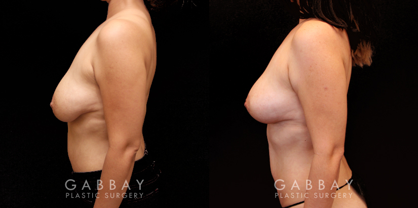 Procedures Depicted:  Breast lift and auto aug