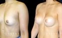 Patient with silicone implants, photos demonstrating final breast size after complete and uncomplicated recovery period. Note the improved profile and side angles, with no visible scarring.