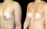 Patient with silicone implants, photos demonstrating final breast size after complete and uncomplicated recovery period. Note the improved profile and side angles, with no visible scarring.