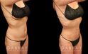 Before and after photos for a mini tummy tuck patient, with combined liposuction around the waist. The combined procedure resulted in notable flattening of the stomach with all fat rolls smoothed out.
