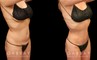 Before and after photos for a mini tummy tuck patient, with combined liposuction around the waist. The combined procedure resulted in notable flattening of the stomach with all fat rolls smoothed out.