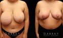 Patient 05 Front View Breast Reduction Gabbay Plastic Surgery
