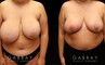 Patient 05 Front View Breast Reduction Gabbay Plastic Surgery