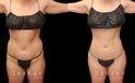 BBL post-op results showing well-settled butt injections for a mild increase in volume and enhancement of overall shape. 360 liposuction of the waist emphasizes the hourglass shape of the body and a natural-looking, slimmer silhouette. All post-op visits showed recovery without complications.
