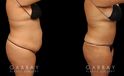 Tummy tuck before and after photos, along with combined liposuction, breast lift, and breast augmentation. Abdominal tightening enhanced the increase in breast volume for a curvier, fitter aesthetic.