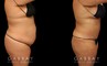 Tummy tuck before and after photos, along with combined liposuction, breast lift, and breast augmentation. Abdominal tightening enhanced the increase in breast volume for a curvier, fitter aesthetic.