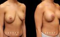 Before-and-after photos for patient who had removal and replacement of silicone implants (capsulorrhaphy). Final procedure included a breast lift to restore the position of the breasts.