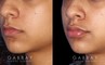 Patient 01 3/4th Left Side View Lip Augmentation Gabbay Plastic Surgery
