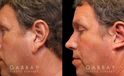 Patient 01 Left Side View Ear reduction Gabbay Plastic Surgery
