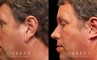 Patient 01 Left Side View Ear reduction Gabbay Plastic Surgery