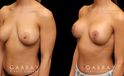 Before-and-after photos for patient who had removal and replacement of silicone implants (capsulorrhaphy). Final procedure included a breast lift to restore the position of the breasts.