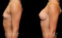 Patient before and after breast augmentation with silicone implants for both breasts. Patient’s naturally slender body type balanced well with smaller implants.