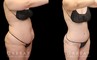 Note the loose skin tightened over the lower abdomen, with no hanging pockets of fat following the patient’s tummy tuck procedure. Before and after photos demonstrate the restoration of a youthful physique and smoother, firm-looking skin around the stomach.