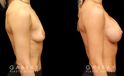 Silicone breast augmentation results after full recovery. Multi-angle view shows the boost to volume from each side for an alluring profile.