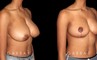 Patient 04 3/4th Right Side View Breast Reduction Gabbay Plastic Surgery