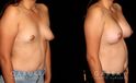 Procedures Depicted:  Breast Augmentation with Lift to Right Breast