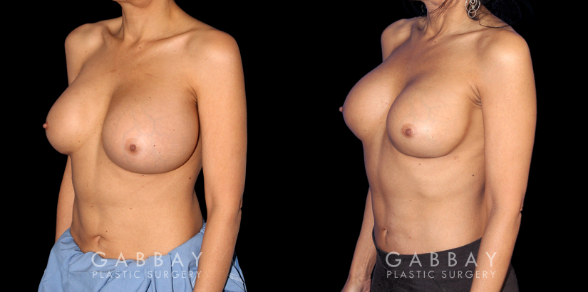 Procedures Depicted:  Breast Revision