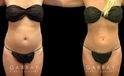 Patient after mild liposuction, demonstrating a significantly flatter stomach area from the profile angle. Patient’s recovery was without complications, and lead to virtually no visible scarring.