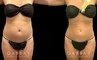 Patient after mild liposuction, demonstrating a significantly flatter stomach area from the profile angle. Patient’s recovery was without complications, and lead to virtually no visible scarring.