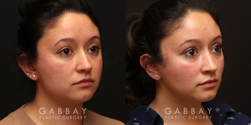 Procedures Depicted:  Buccal Fat Pad Removal