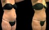Patient after mild liposuction, demonstrating a significantly flatter stomach area from the profile angle. Patient’s recovery was without complications, and lead to virtually no visible scarring.