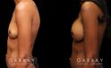 Patient before-and-after photos for breast augmentation with silicone implants. Patient increased cup size while maintaining a natural, balanced look to the breasts.