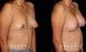 Before-and-after photos for patient with unilateral breast lift and bilateral breast augmentation. The improved symmetry restored a more natural look to the breasts with even nipple position.