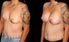 Procedures Depicted:  Breast Augmentation with Lift to Right Breast