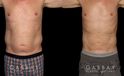 Male patients with liposuction results for full abdominal contouring. Patient healed well with minimal visible scarring and a flat stomach as seen in the profile view.